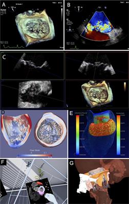 Anatomy of a Transcatheter Mitral Valve Service